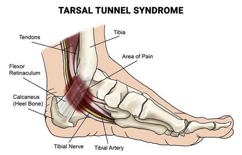 Tarsal Tunnel Syndrome - Premier Podiatry: Velimir Petkov, DPM: Podiatrists: Clifton, NJ