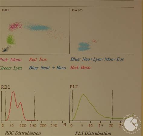 Dimorphic anemia presentation in patient with iron deficiency 2