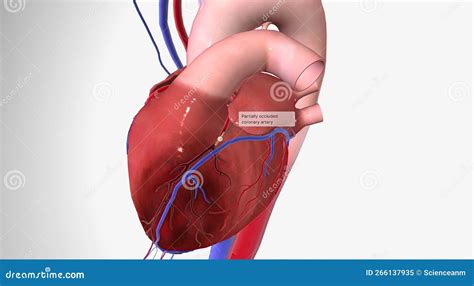 Angina is Chest Pain or Discomfort Due To Reduced Blood Flow To the Heart Stock Illustration ...