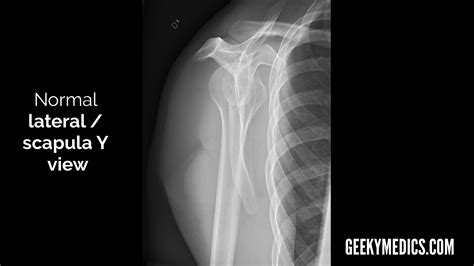 Shoulder X-ray Interpretation | Radiology | Geeky Medics