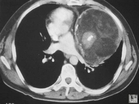 Mediastinal Teratoma | Pet ct, Hemorrhage, Medical imaging