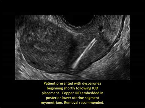 How to identify and localize IUDs on ultrasound | MDedge ObGyn