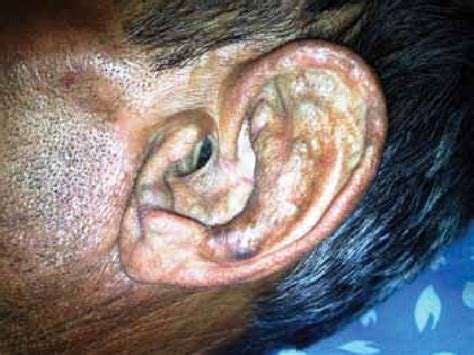 Discoloration and deformity of the pinna and damaged cartilaginous ...