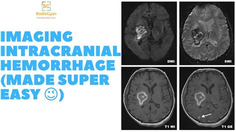 Brain Hemorrhage CT / MRI (Made Super Easy!) - Radiology Video Tutorial! - YouTube