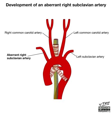 Radiopaedia - Drawing Aberrant right subclavian artery - English labels | AnatomyTOOL