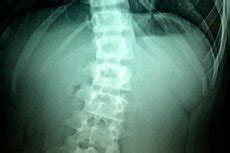 Spinal shock: causes, pathogenesis, treatment