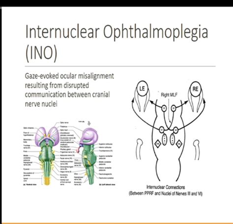 Ocular Disease III: Internuclear opthalmoplegias and skew deviation Flashcards | Quizlet