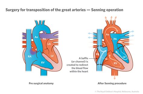 Cardiology : Transposition of the Great Arteries