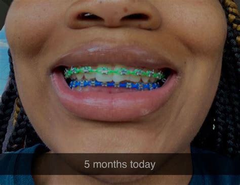 Braces black girl in 2022 | Cute braces colors, Braces tips, Braces colors