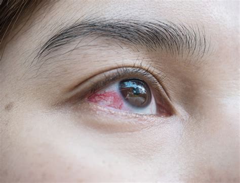 Are Those Symptoms What You Think? - Eye Institute of Houston