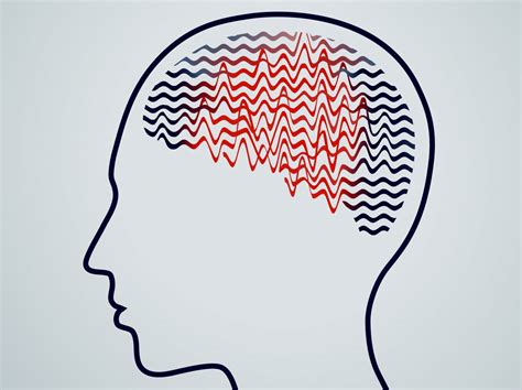 Understanding Epilepsy: Causes, Symptoms, and Treatments - My Press Plus