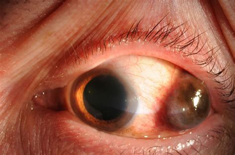 Moran CORE | Conjunctival Melanoma