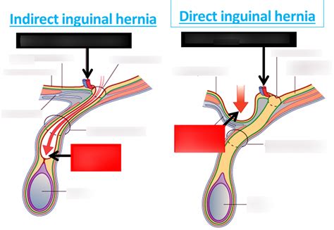 Indirect Inguinal Hernia Female