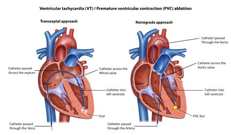 PVC VT Ablation - Melbourne Heart Group