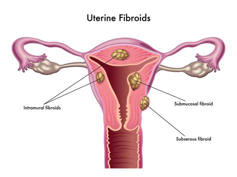 Fibroids (Leiomyomas) of the Uterus - Ob/Gyn Keith J. Reisler, MD Plano | Dr. Reisler, M.D., P.A.