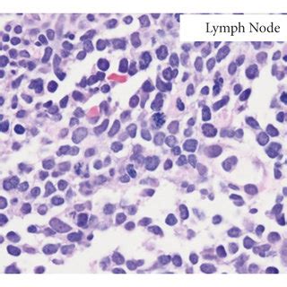 (a) Wright–Giemsa stain of peripheral blood smear shows circulating... | Download Scientific Diagram