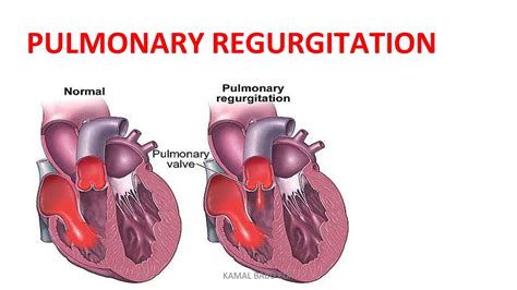 PULMONARY REGURGITATION - YouTube