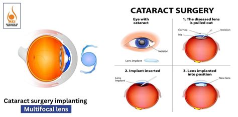 Cataract Surgery Implanting Multifocal Lens – Rotary Eye Hospital