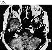 Eye Enucleation photo – The Disabled List