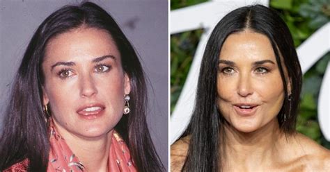 Demi Moore's Shocking New Face, Plastic Surgeons Weigh In