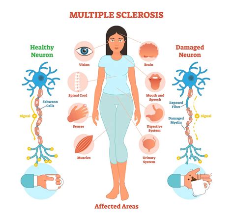 Multiple Sclerosis System Disorder Template - Printable Word Searches