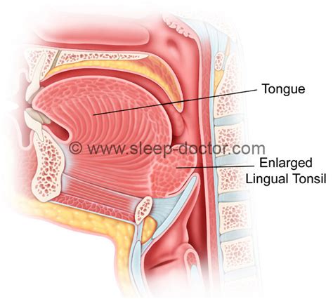 My Lingual Tonsil Is Swollen Online Here | www.deborahsilvermusic.com