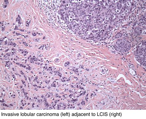 Pathology Outlines - Invasive lobular carcinoma