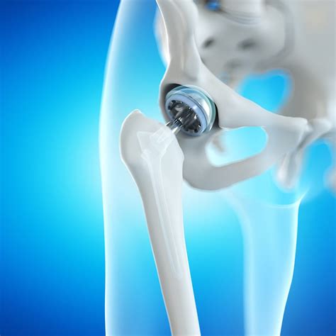 Anterior Hip Replacement - Southern Utah Orthopaedic Surgery Center ...