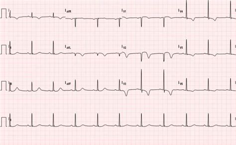 Wellens’ Sign (Wellens’ Syndrome) - JETem