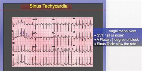 Paroxysmal Atrial Tachycardia Vs Sinus Tachycardia