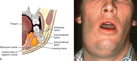 Sublingual Abscess