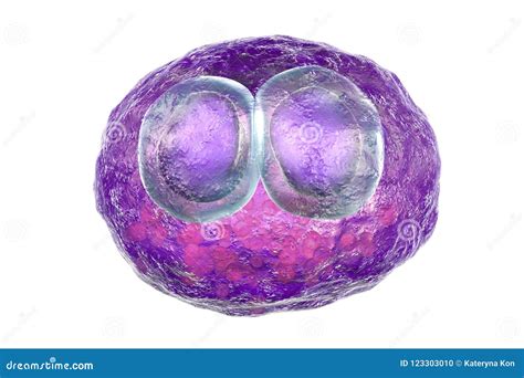 Cytomegalovirus CMV Inside Human Cell, Owl`s Eye Inclusion in the Nucleus, Multinucleated Cell ...