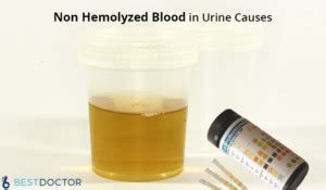 Non Hemolyzed Blood in Urine Causes | Hematuria Causes During Pregnancy