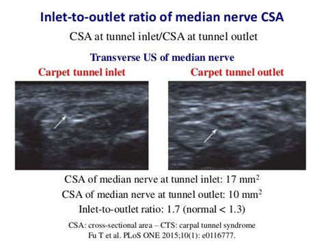 Ultrasound of carpal tunnel syndrome