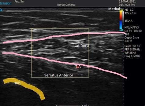 Ultrasound Guided Serratus Anterior Plane Block – RCEMLearning India