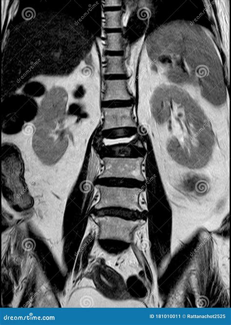 Burst Fracture At Lumbar Spine Stock Image | CartoonDealer.com #40239001