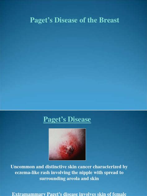 Paget's Disease PP | PDF | Breast Cancer | Neoplasms