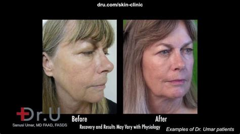 Video: Jowl Reduction without Surgery in Beverly Hills Los Angeles Patient