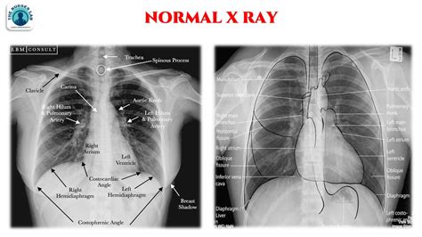 Chest xray normal vs abnormal - startlynx