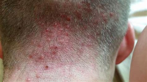 Inflamed Hair Follicle On Shaft