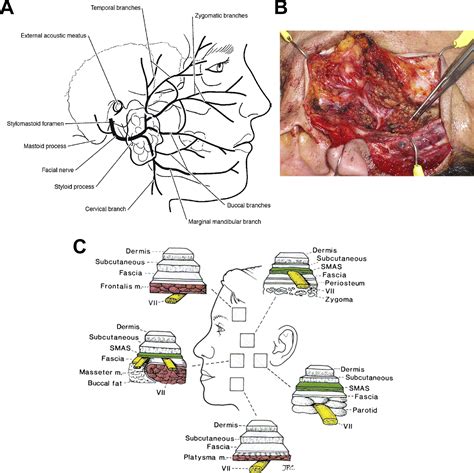 Facial Nerve and Parotid Gland Anatomy - Otolaryngologic Clinics of ...