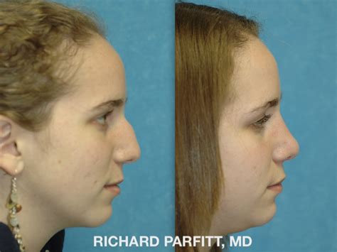 Rhinoplasty Before and After Photos - Dr. Richard Parfitt