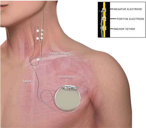 Placement of vagus nerve stimulation device. As illustrated in the... | Download Scientific Diagram