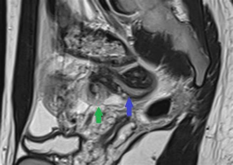 Fallopian tube and ovarian torsion- paratubal cyst | Image ...