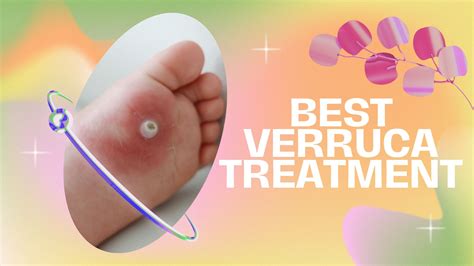 Best Verruca Treatment