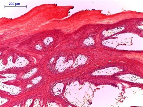 Figure 1 from Squamous Papilloma of the Tongue: A case report ...