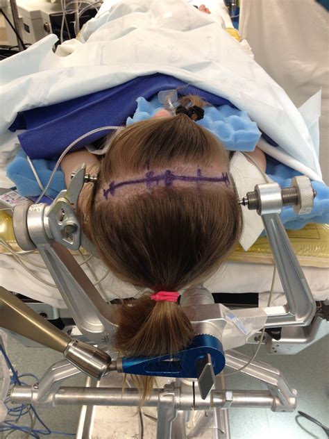 Corpus callosotomy—Open and endoscopic surgical techniques - Smyth - 2017 - Epilepsia - Wiley ...