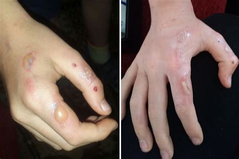 Giant Hogweed: Warning after boy Jacob Lambert suffers burns | Daily Star