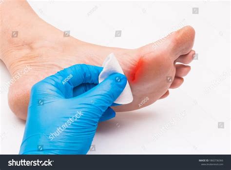 Diabetic Foot Reconstruction - Dr Y Suneel Kishore - Usha Plastic ...