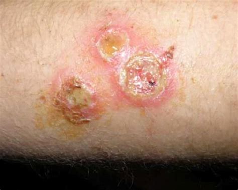 Staph Infection Causes, Symptoms, and Treatment - Natural Health News